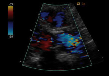 color flow Doppler of Trifecta tissue valve during systole