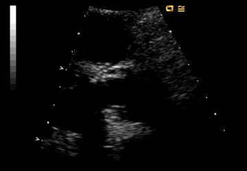 echo of Trifecta heart valve during diastole, long axis