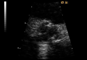 echo of Trifecta aortic valve during diastole, short axis