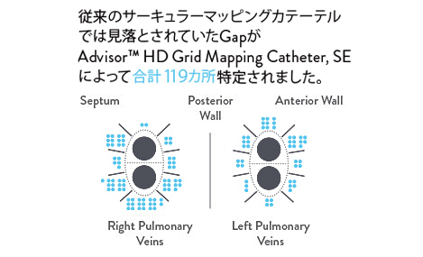 12 total gaps missed by the Achieve Mapping Catheter were identified by the Advisor HD Grid Mapping Catheter, SE.