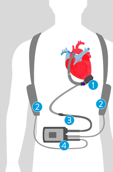 Diagram of the HeartMate 3 LVAD system on an outline of a person.
