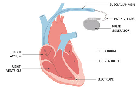 Heart illustration with pacemaker