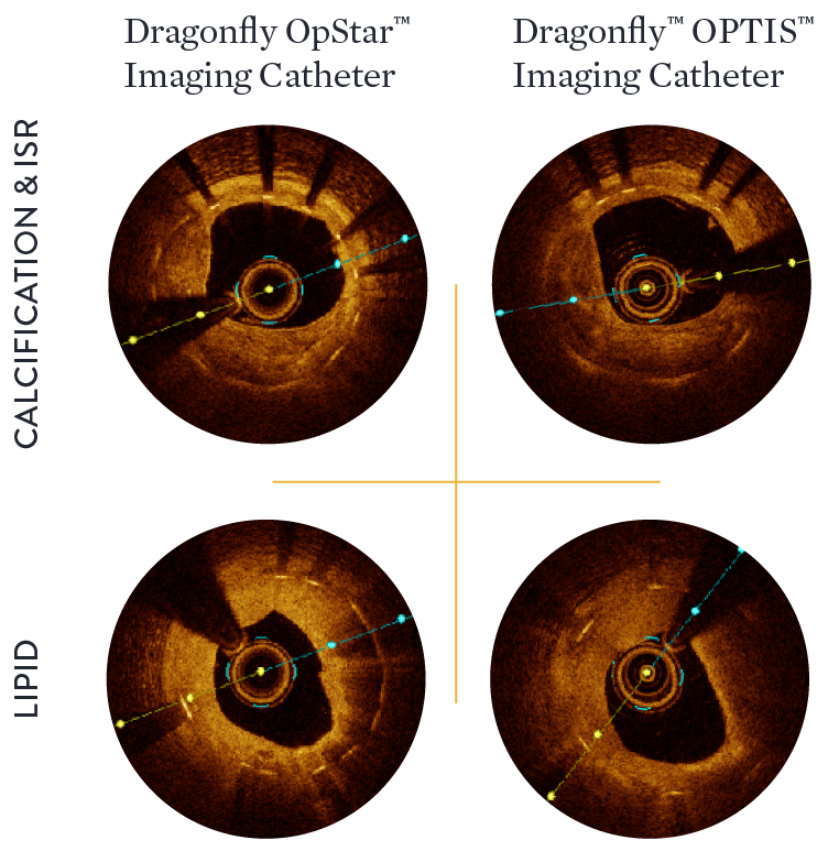 *Data on file at Abbott. Comparative claims versus the previous generation of the device, Dragonfly™ OPTIS™ Imaging Catheter