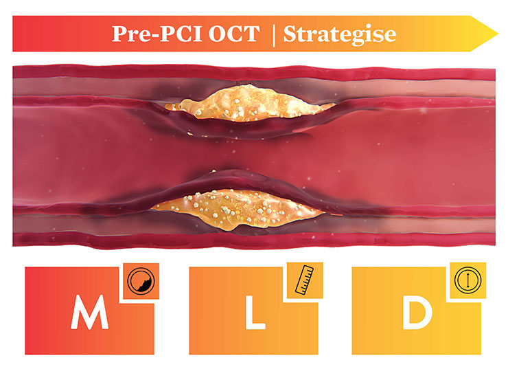 Pre-PCI OCT Strategize