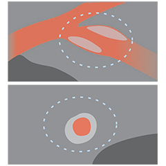 Coronary Angiography image