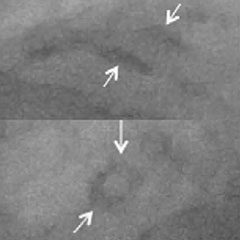 IMAGING MODALITIES - Coronary Angiography Image