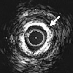 IMAGING MODALITIES - IVUS image