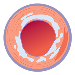 IVUS image