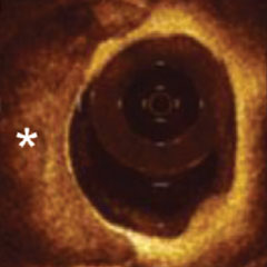 IMAGING MODALITIES - OCT image