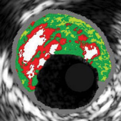 IMAGING MODALITIES - RF-IVUS (IVUS-VH) image