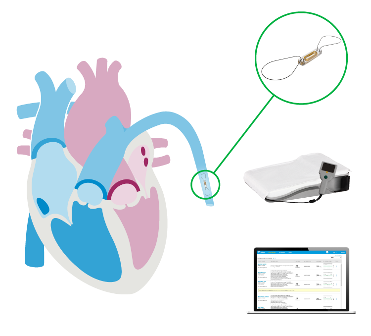 The CardioMEMS HF System Patient Conversation Abbott