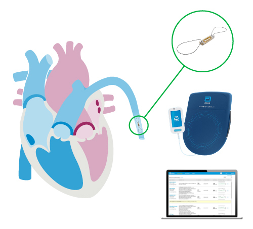 How the CardioMEMS System works
