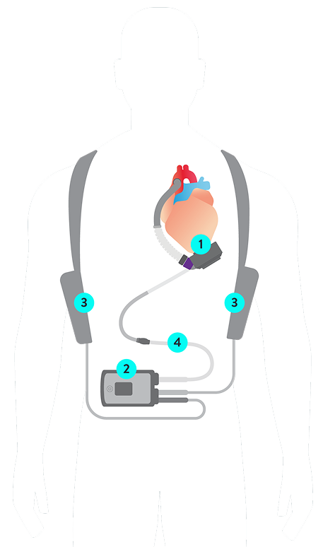 HeartMate 3 LVAD parts