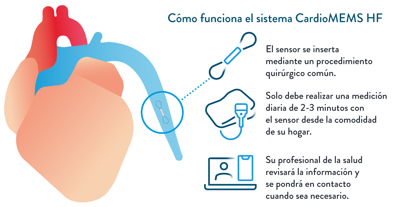 How the CardioMEMS HF System works