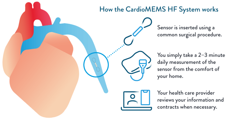 How the CardioMEMS HF System works