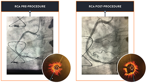 RCA Procedures