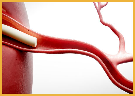 CATH CMD Catheter Engagement