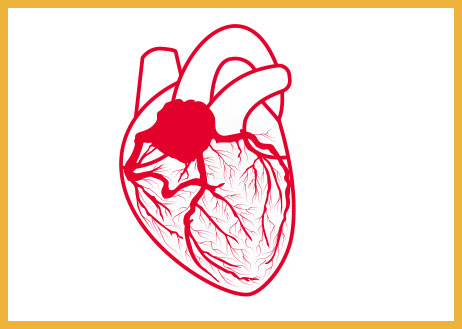 CATH CMD Coronary Flow Reserve (CFR)