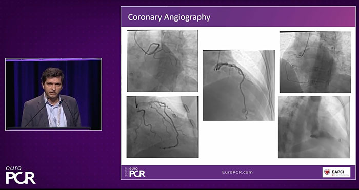 INOCA Patient Case: Coronary Microvascular Dysfunction (CMD) Diagnosis