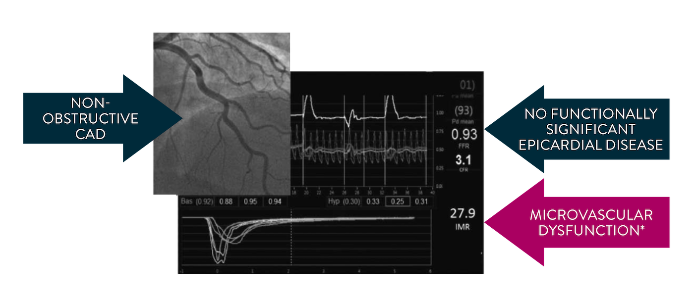 Angina and negative angiogram could mean CMD