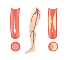 Symptoms of Peripheral Artery Disease (PAD)