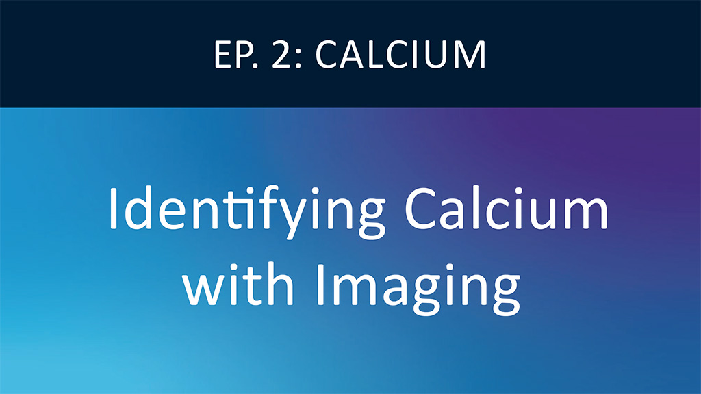 Identify Calcified Lesions with Intravascular Imaging Video
