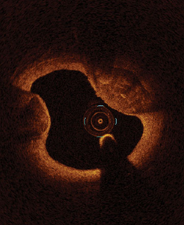  Calcified nodules