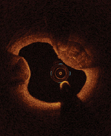  Calcified nodules