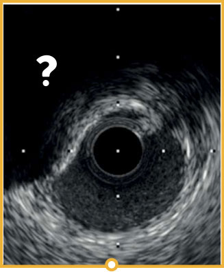 Evaluation of calcium by IVUS vs OCT vs angiography