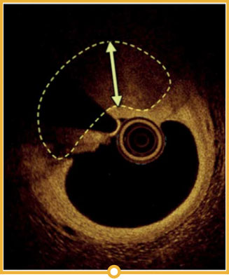 Evaluation of calcium by IVUS vs OCT vs angiography