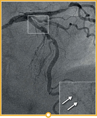   Evaluation of calcium thickness