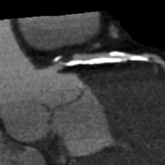 PCI OCT compare CT