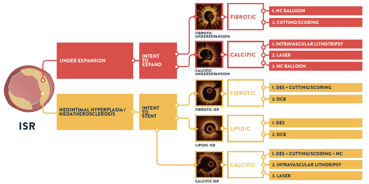 pci oct isr treatment algorithm