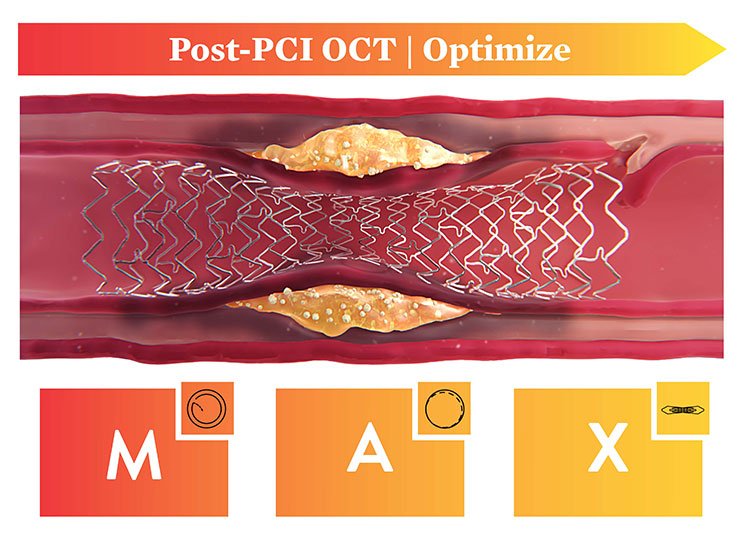  Post-PCI OCT Optimize