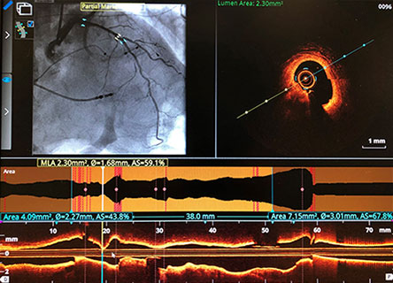 pci oct prepci mld screen