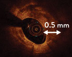 calcium score algorithm to identify calcific lesions that would benefit from plaque modification before stent implantation