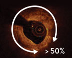 calcium score algorithm to identify calcific lesions that would benefit from plaque modification before stent implantation