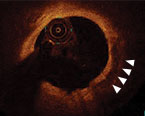 calcium score algorithm to identify calcific lesions that would benefit from plaque modification before stent implantation