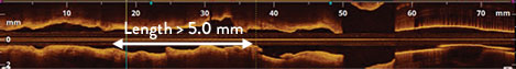 calcium score algorithm to identify calcific lesions that would benefit from plaque modification before stent implantation