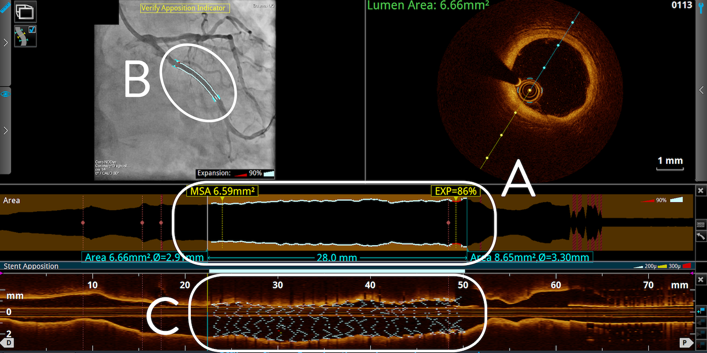 pci oct tapered stent expansion screen