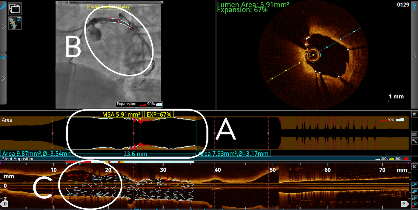 pci oct tapered stent underexpansion screen