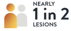  Nearly one in two lesions graphic