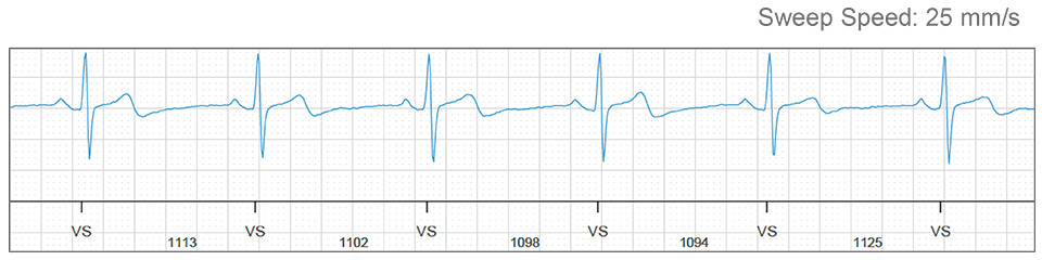 sweep speed EKG graph