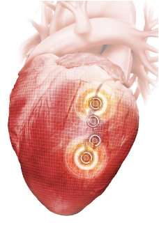  Better management of heart failure symptoms