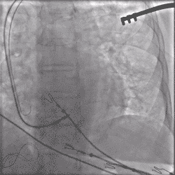 Ensuring optimal slack during stylet retraction is key to preventing complications