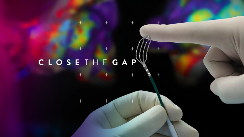 Advisor HD Grid Mapping Catheter, Sensor Enabled Technology Close The Gap