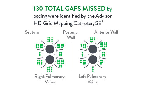 130 total gaps missed by pacing were identified by the Advisor HD Grid Mapping Catheter, SE.