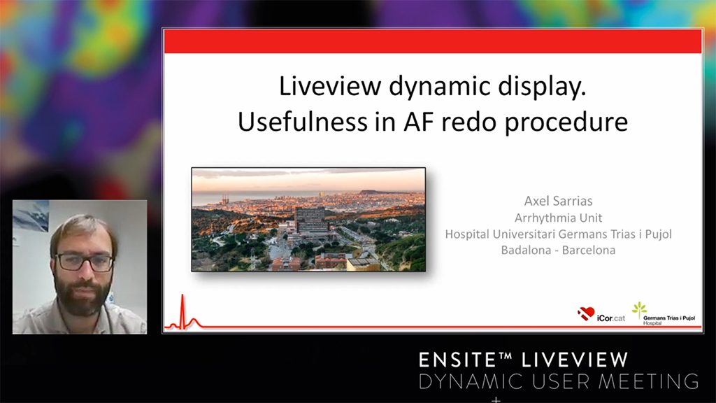 Live Dynamic Visualization of the Pulmonary Veins and the comparison of HD Mapping detection with the pre-procedure DE-MRI Imaging in gaps identification