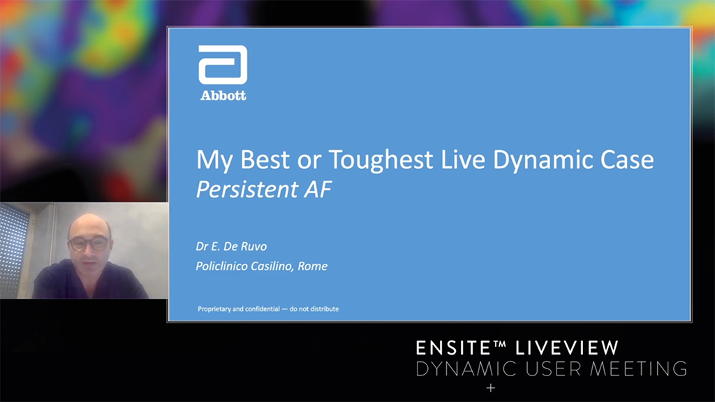 Persistent AF combining the High Density Static Map with the new Live Dynamic Visualization of the Left Atrium