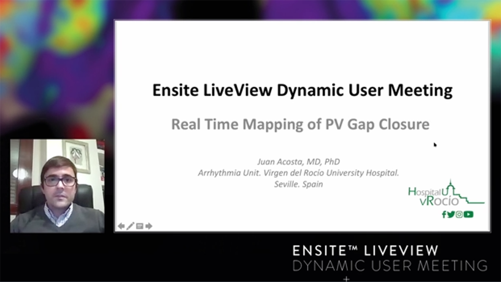 Live Dynamic Visualization of the Pulmonary Veins and the advantage of HD Mapping in comparison to the Standard Circular Catheter